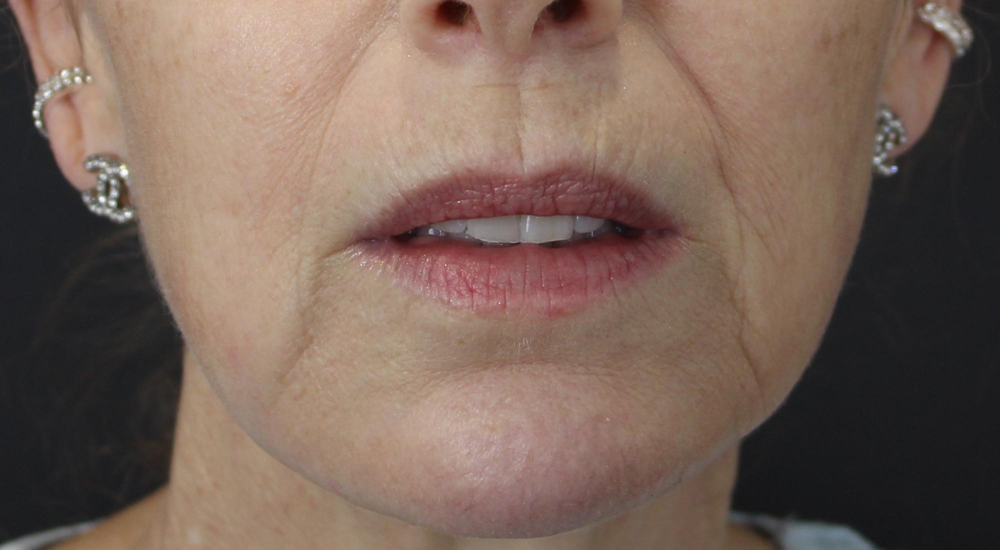 Before treatment with Dr Natasha Cook