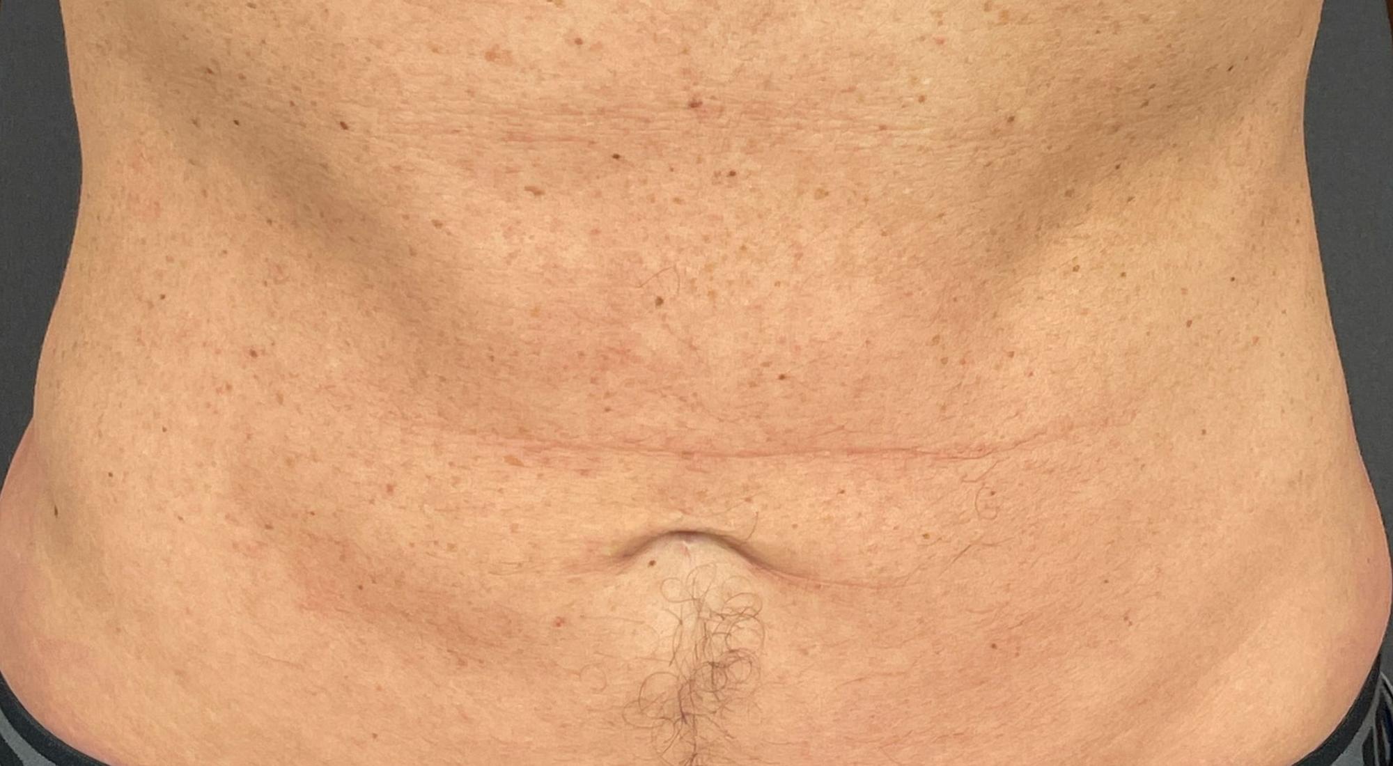 After Morpheus8 non surgical abdomen tummy-tuck and skin tightening lifting stretch marks