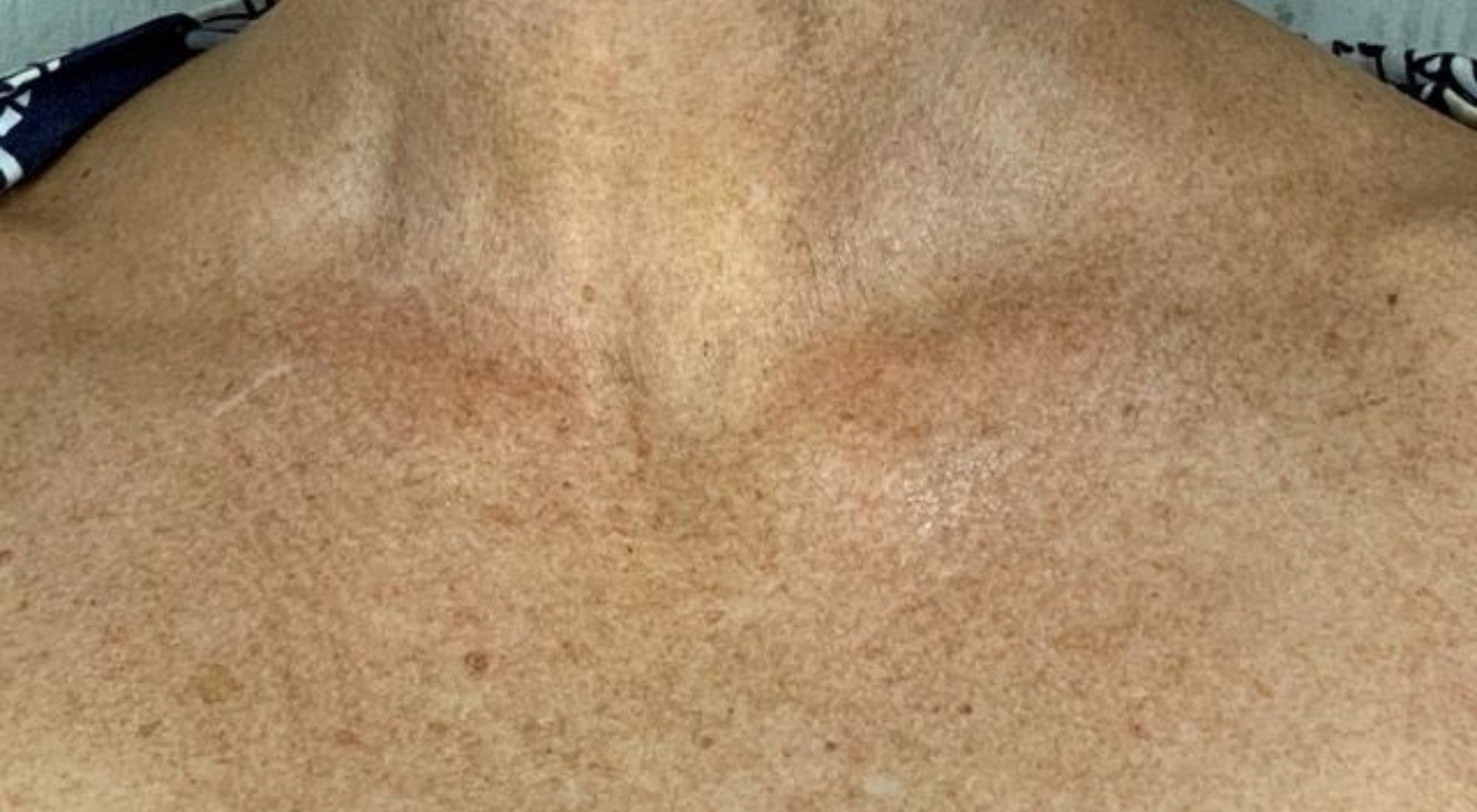 Before treatment for pigmentation to chest