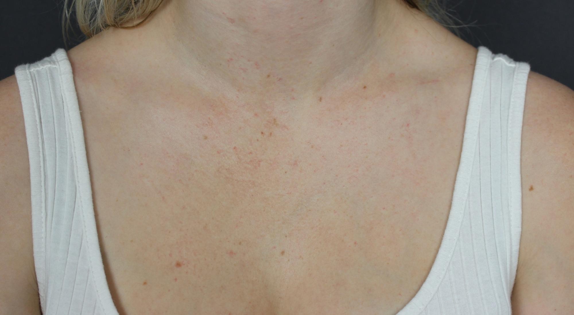 After Cutera vascular treatment for birthmark on chest