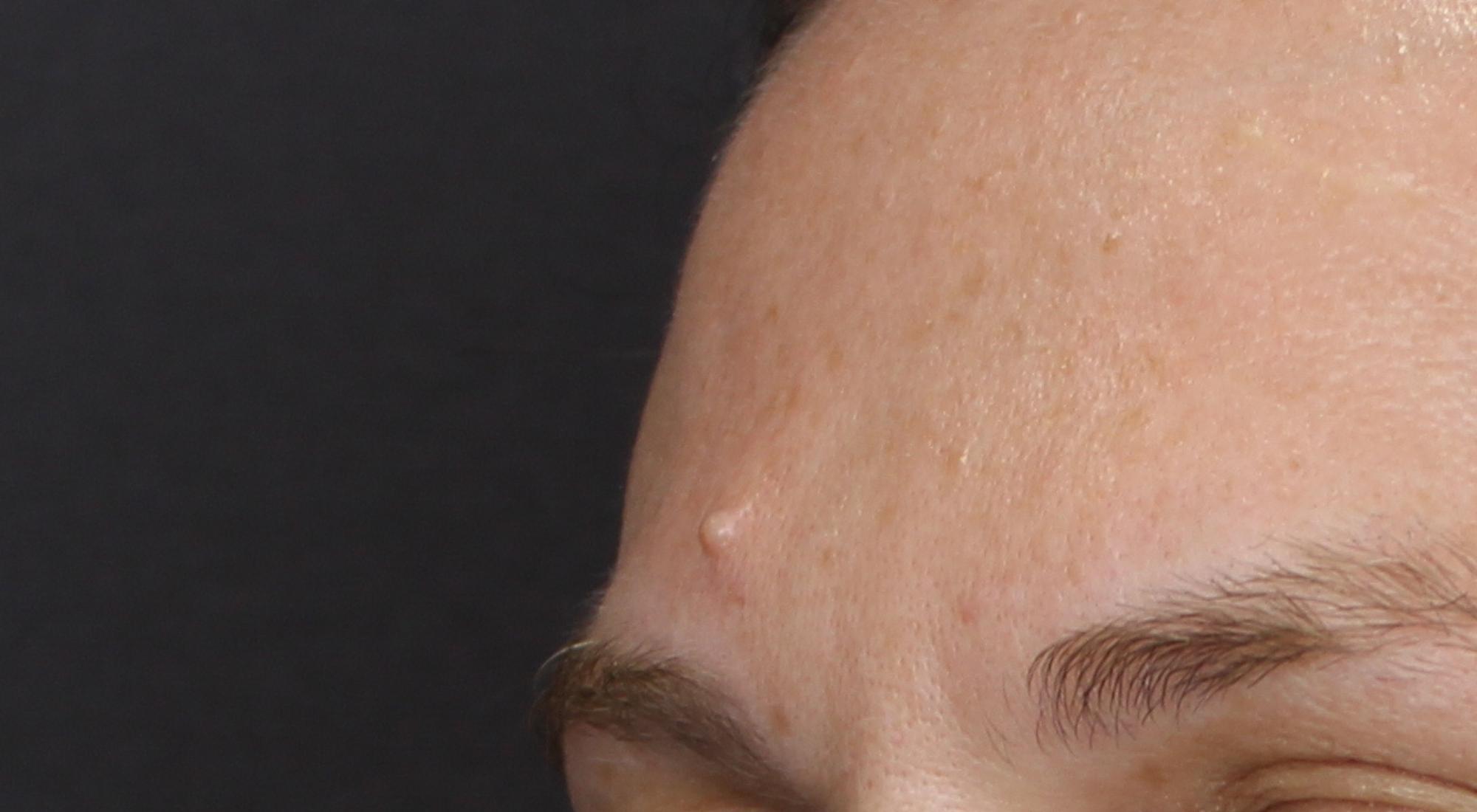 A woman has a large lumpy mole protruding from her forehead