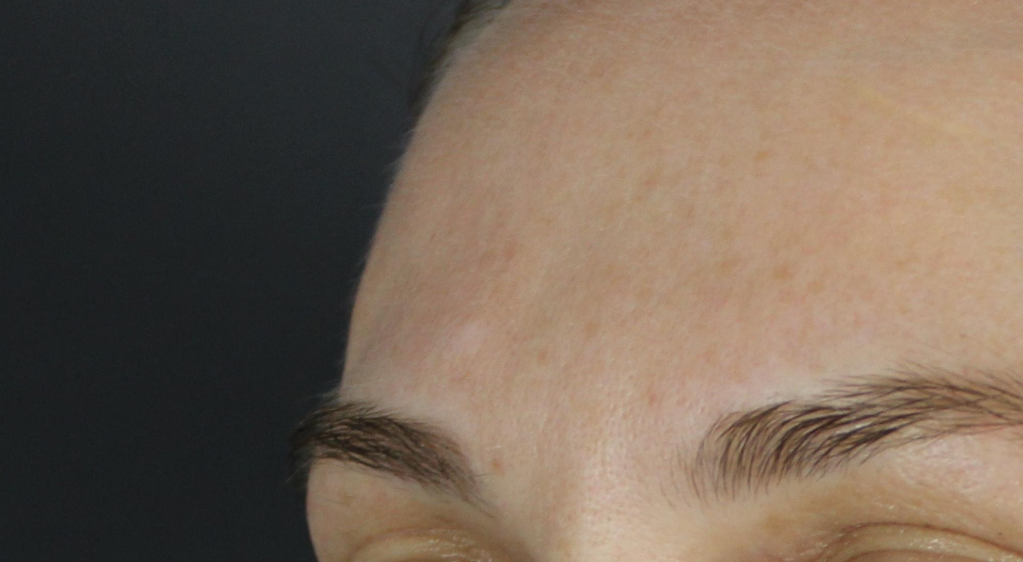 The lesion is significantly reduced and barely visible after dermatology treatment