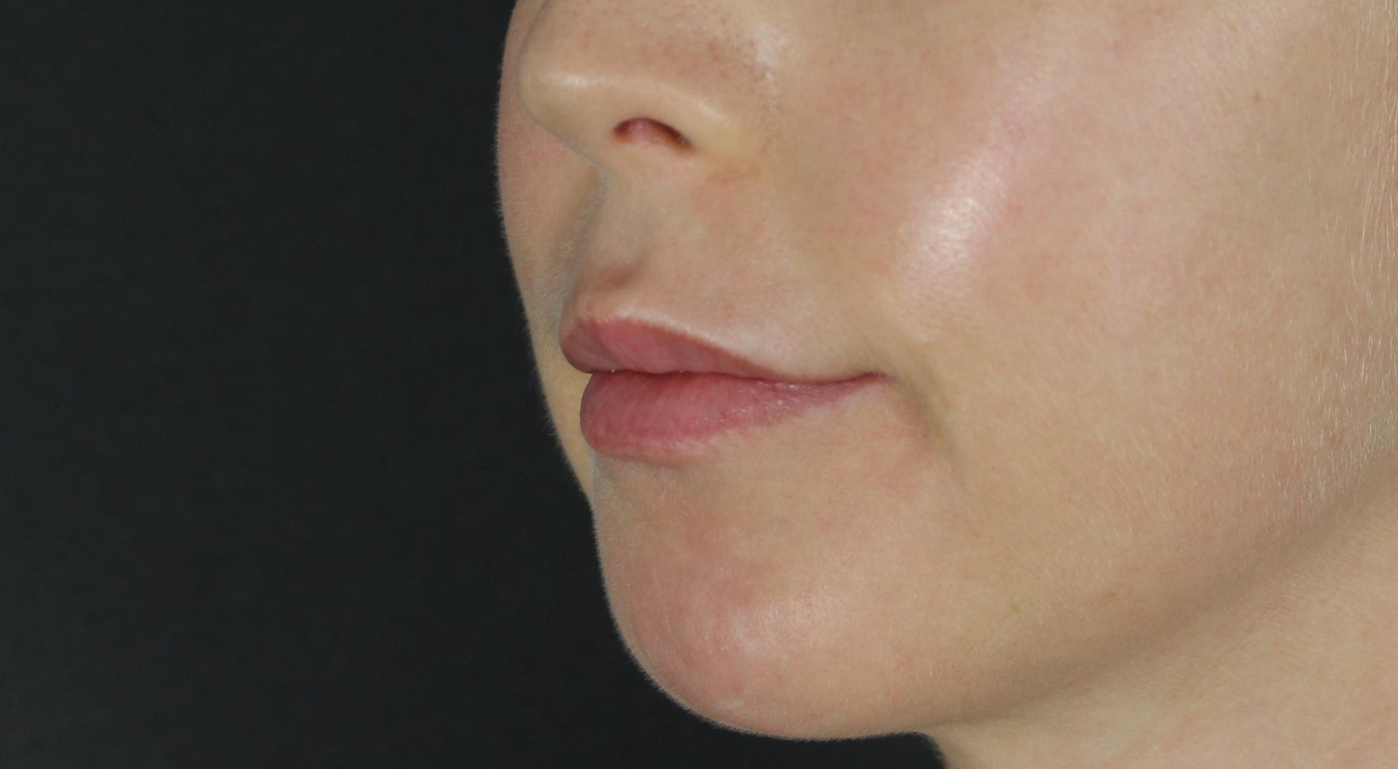 After chin filler for volume and lower face balancing with Dr Natasha Cook