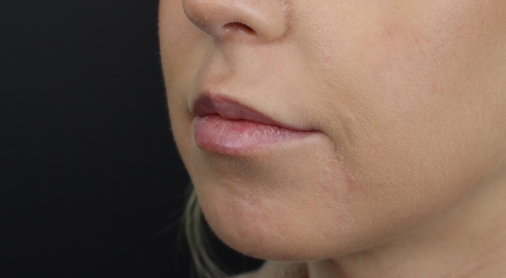 Before chin filler for volume and lower face balancing with Dr Natasha Cook
