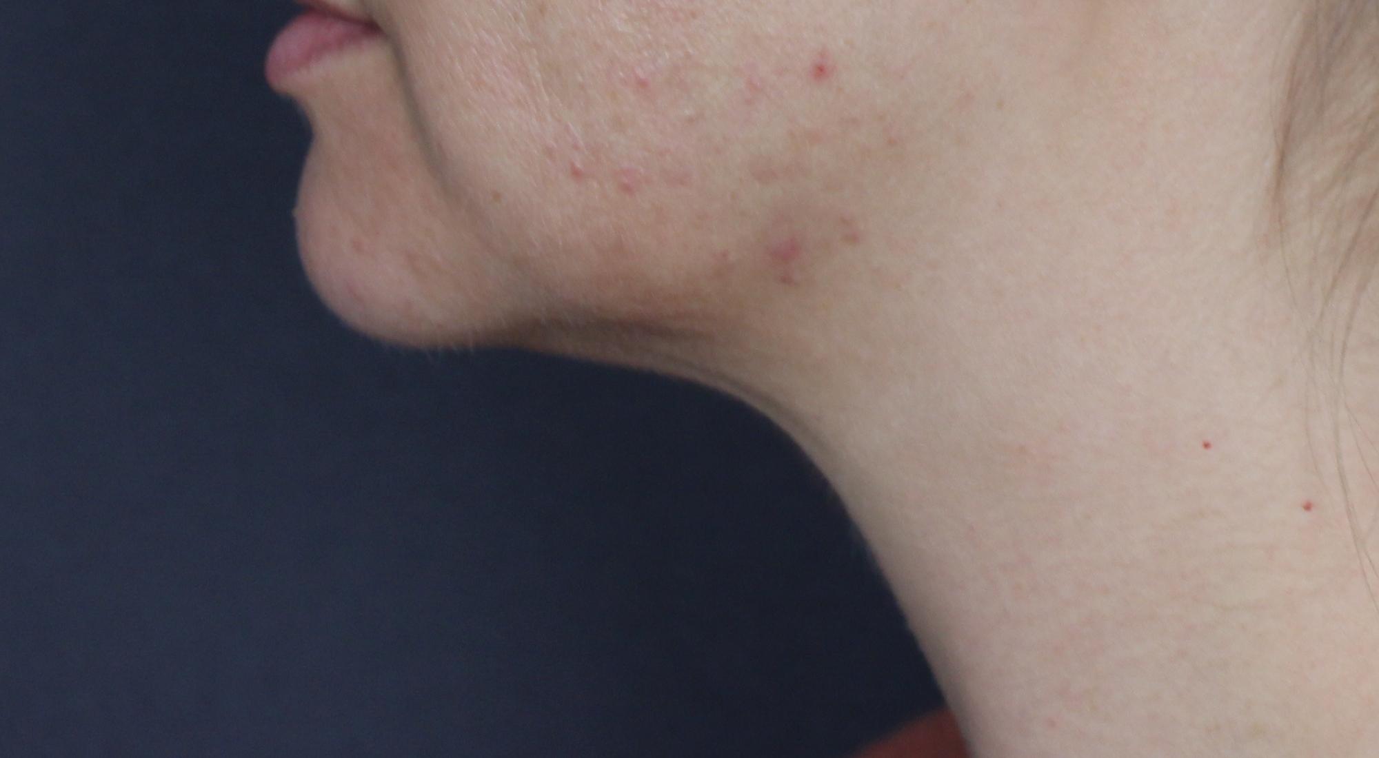 After Belkyra fat dissolving injections with Dr Natasha Cook dermatologist under chin submittal fat jawline contouring in Sydney