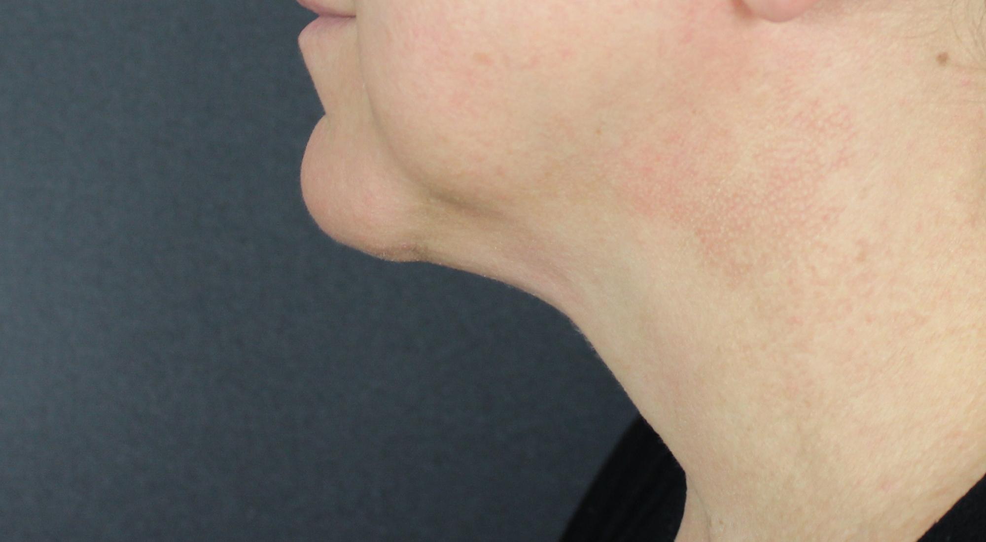After Belkyra fat dissolving injectables