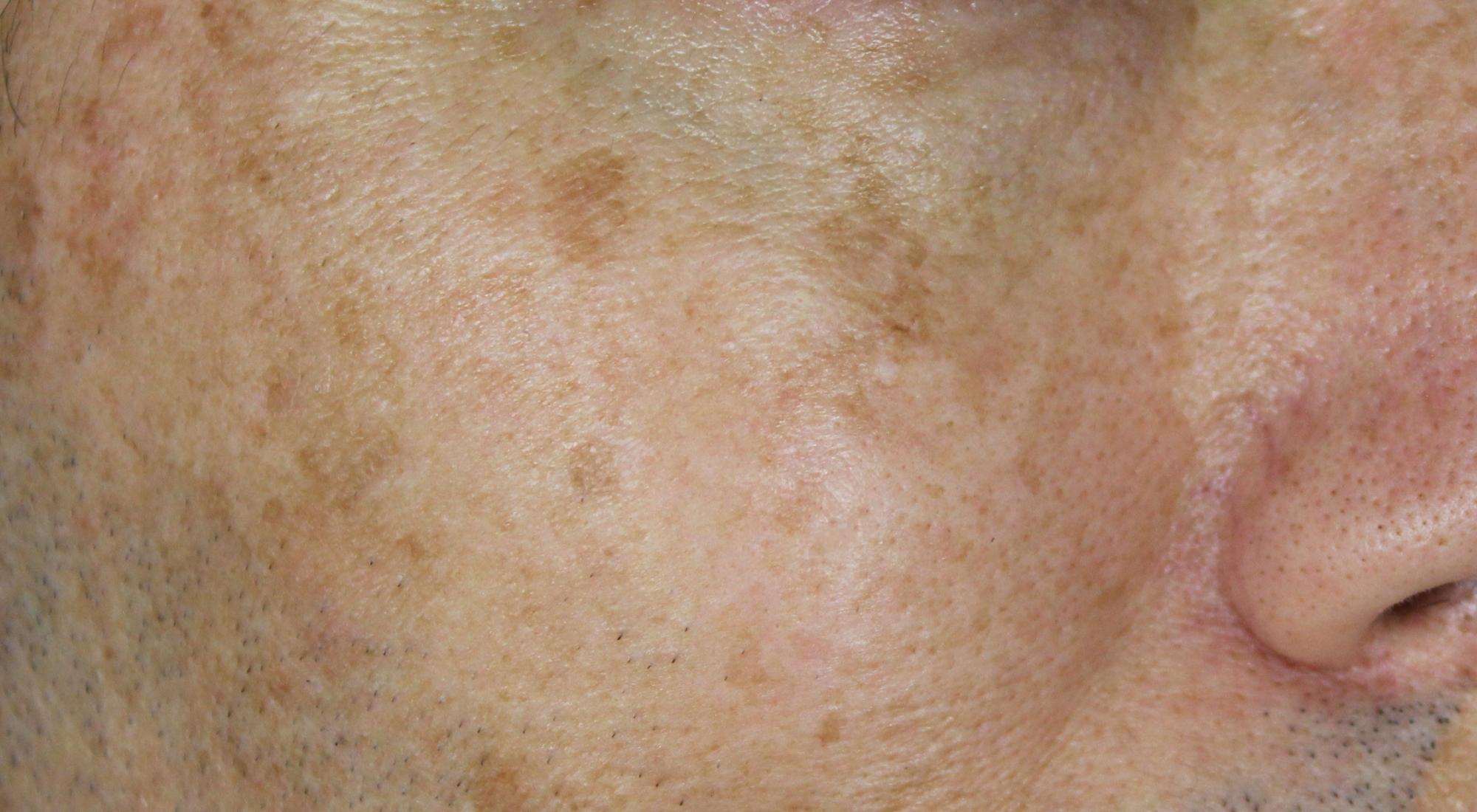 Treating pigmentation on darker skin type IV