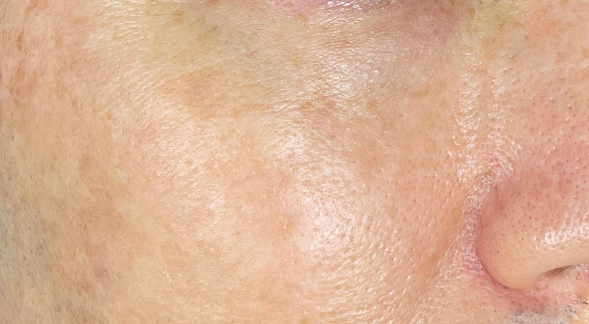 After treatment IPL for pigmentation without PIH by dermatologist Dr Natasha Cook