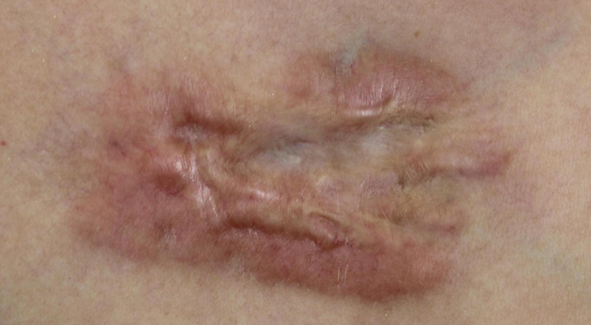 Before treatment for a Keloid scar with topical steroid injection