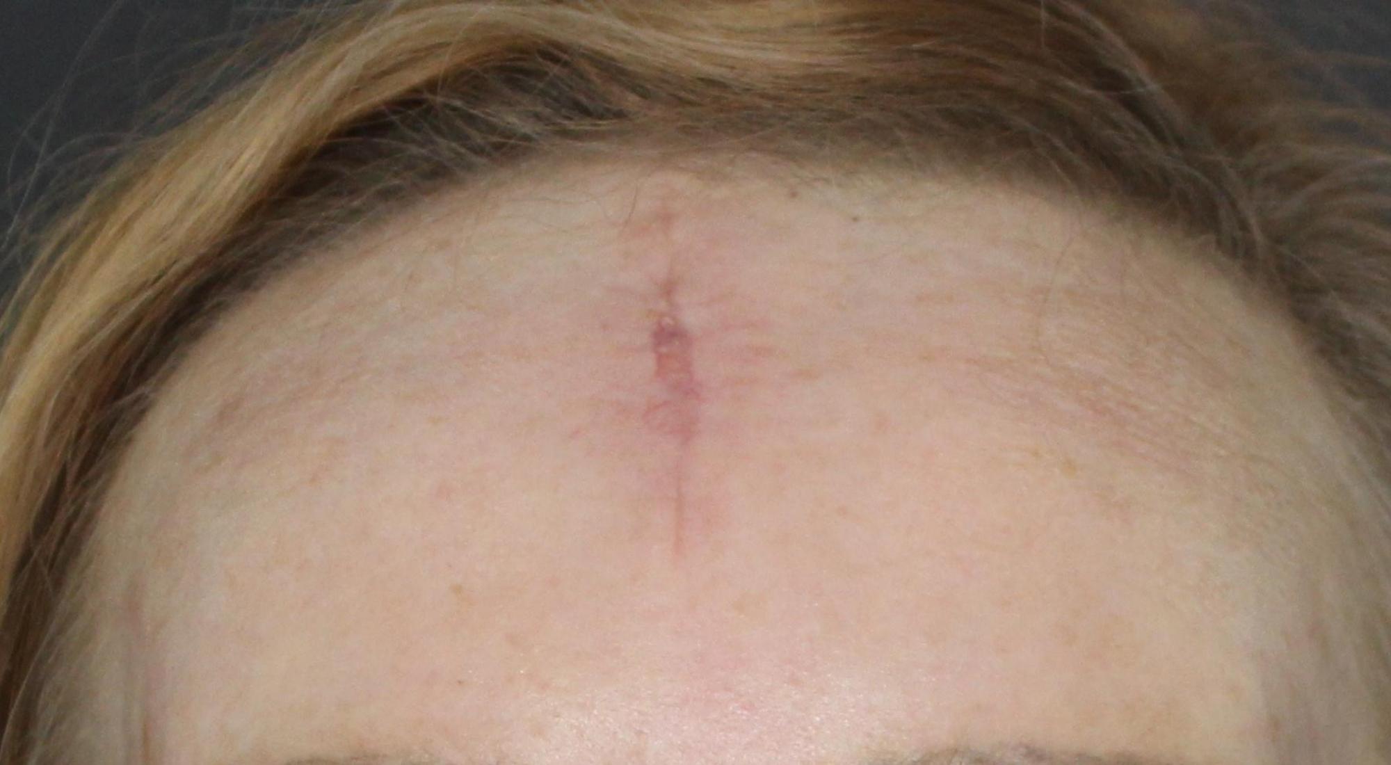 Before treatment to surgical scar with CO2 and pro fractional laser