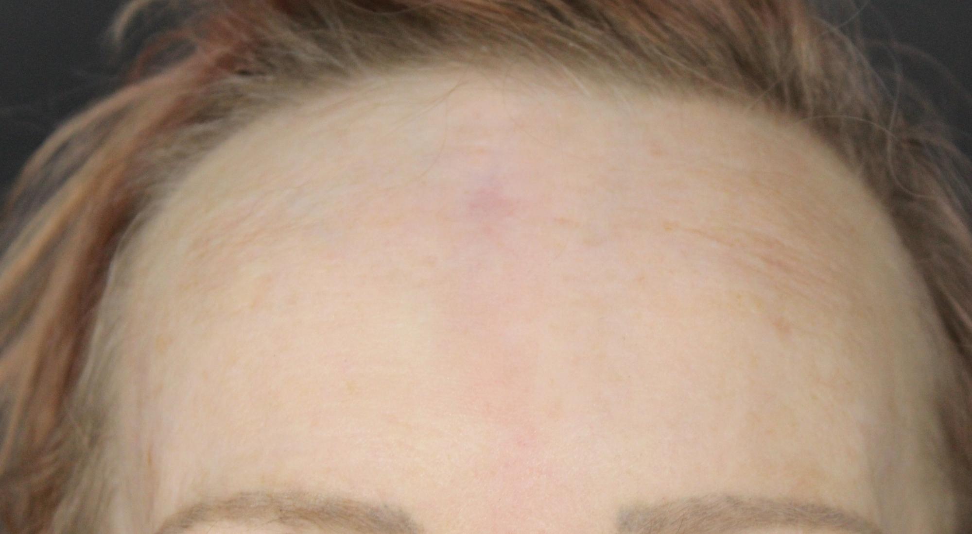 After treatment to surgical scar with CO2 and pro fractional laser