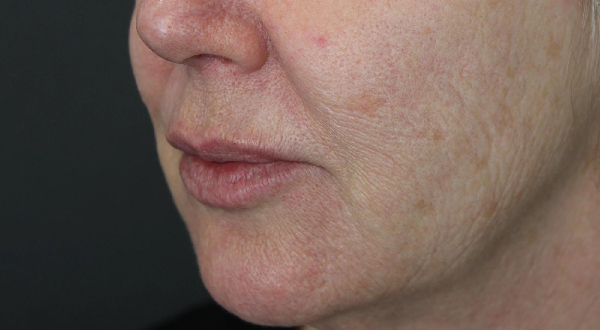 Treating sun damage