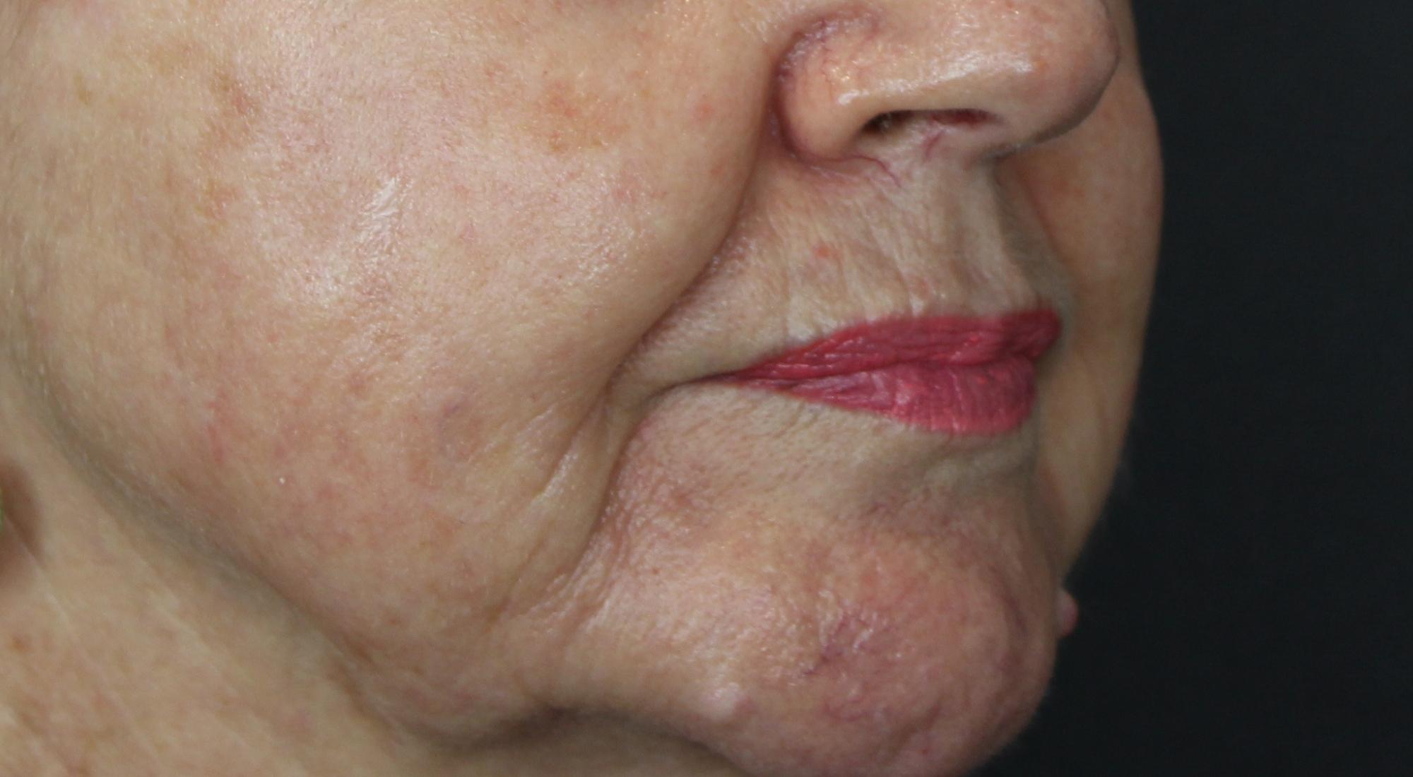 Before BBL and Morpheu8 treatment for pigmentation and skin laxity