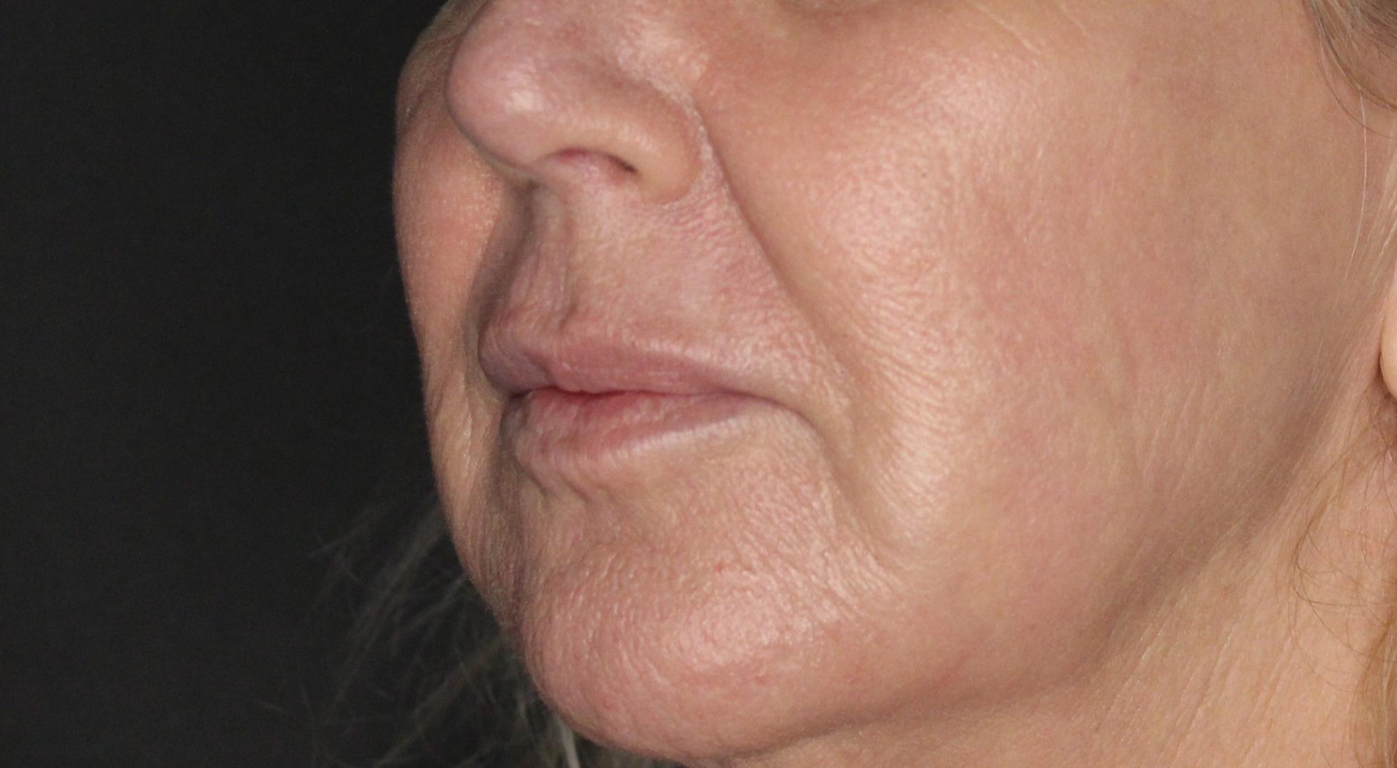 After laser treatments and Morpheus8 radio frequency the skin tone is even, there is visible reduction in fine lines, skin laxity.