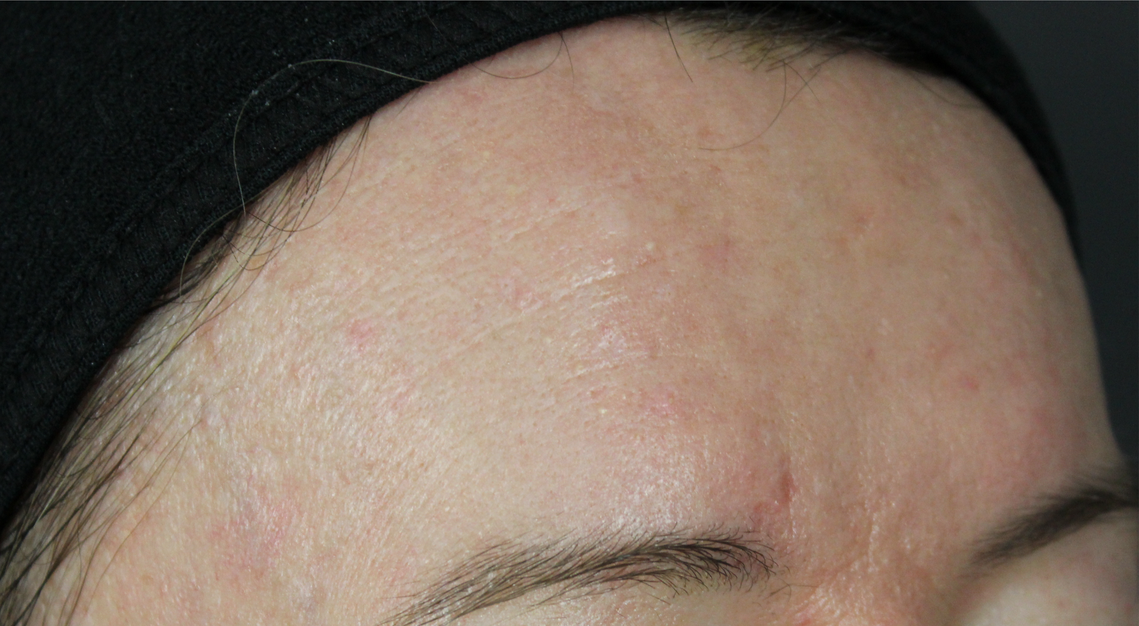 After Alma Hybrid fractionated co2 laser for acne scars in Sydney Australia dermatologist dr Natasha cook Darlinghurst