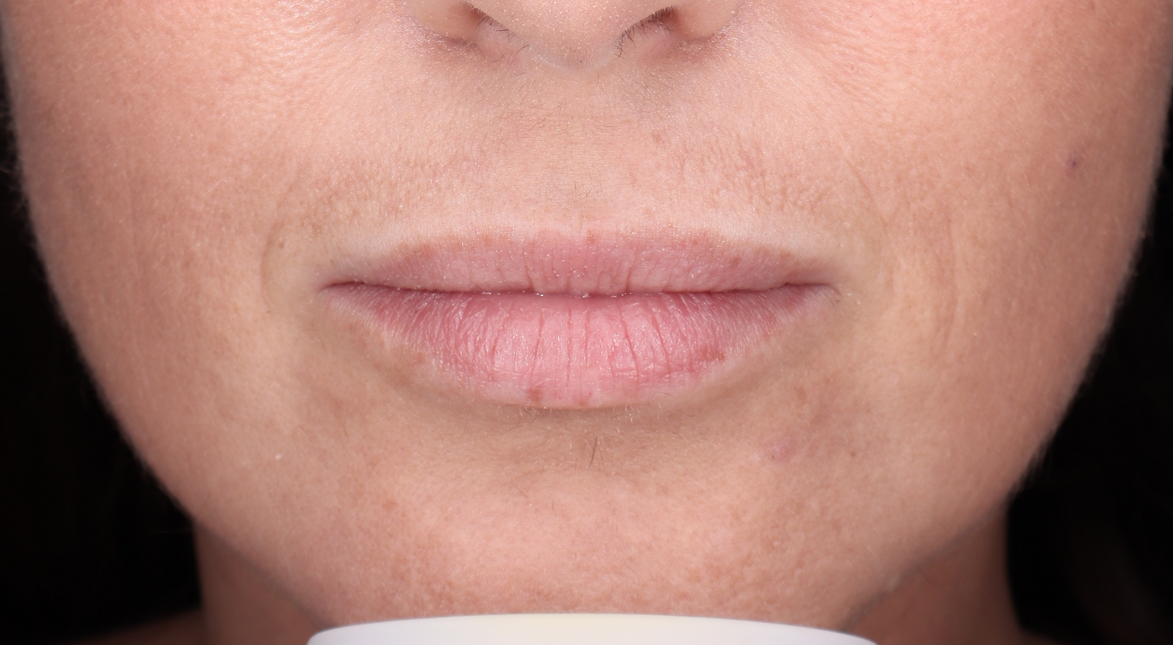 Before lip filler natural lips in Sydney Darlinghurst dermatology dr Natasha cook