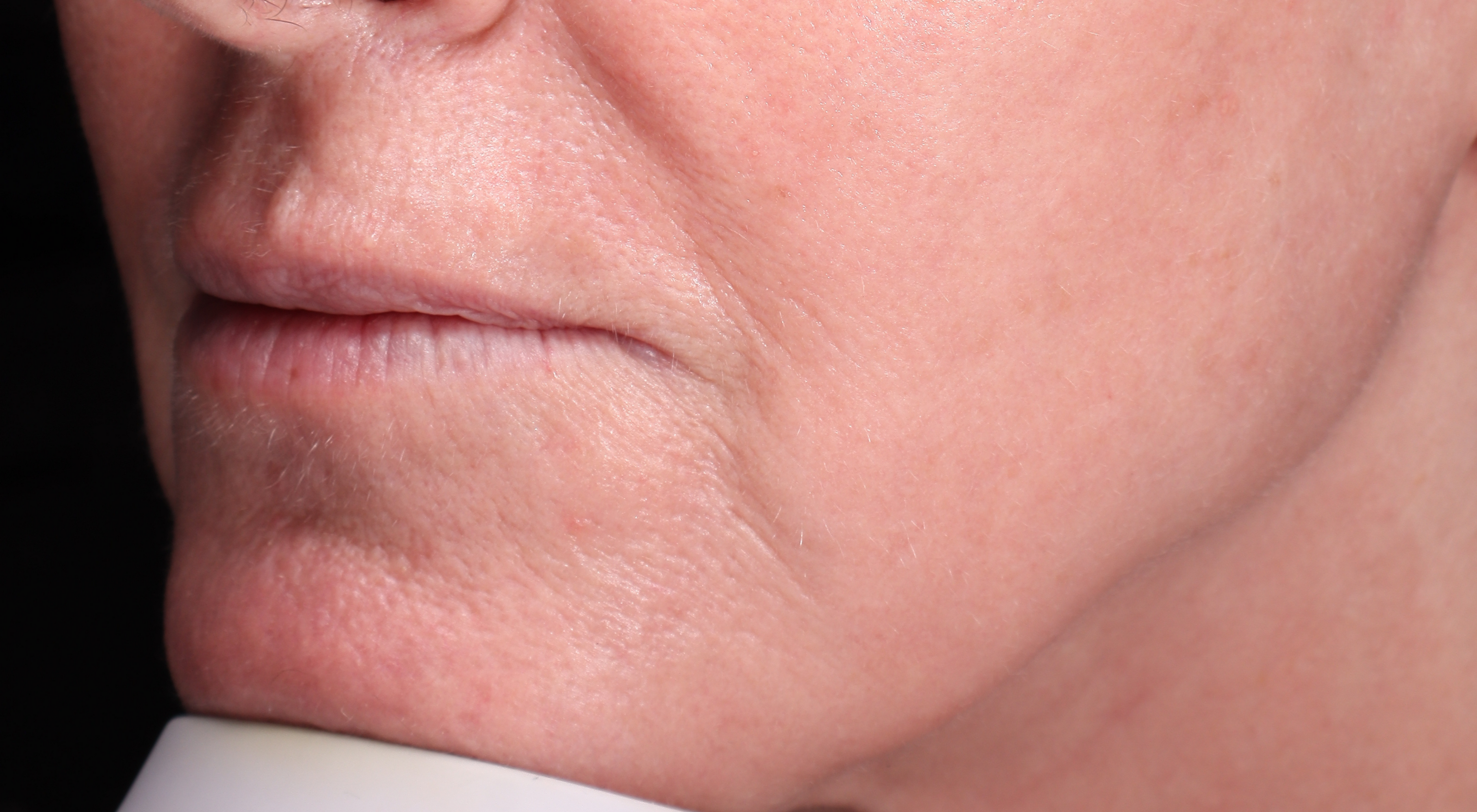 After Perioral Alma Hybrid laser vermilionectomy. Nasolabial folds treatment in Sydney Dr Natasha Cook The Face Bar by dr.NC. Fine lines wrinkles sun damage