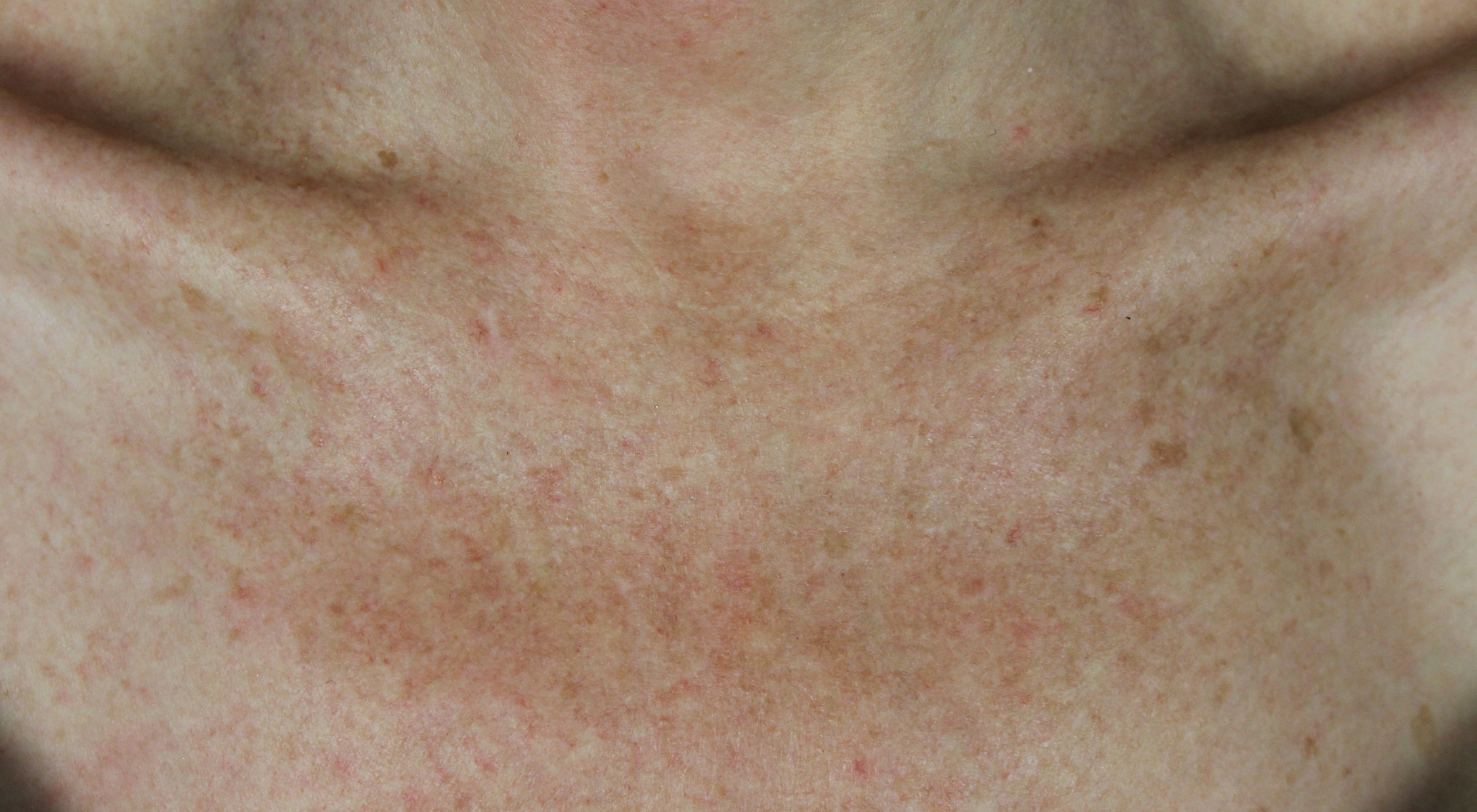 Before BBL treatment Cutera pigmentation sun damage brown and red spots on chest and décolletage